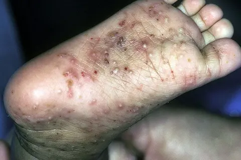 The nationwide MDA is recommended following a scabies prevalence survey conducted in 2021 that reported more than 23% of the Solomon Islands population live with scabies in the communities.