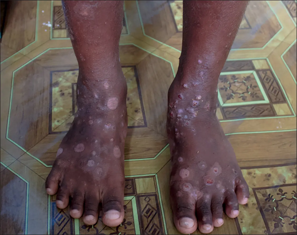 Scabies is endemic in the Solomon Islands and according to last year’s survey conducted in 10 villages in all the province, the prevalence rate for scabies is as high as 72 percent.