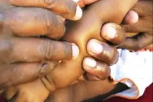 Permanent Secretary Dr Lester Ross said the 35 percent budget reservation has had negative impacts on the country's health services.