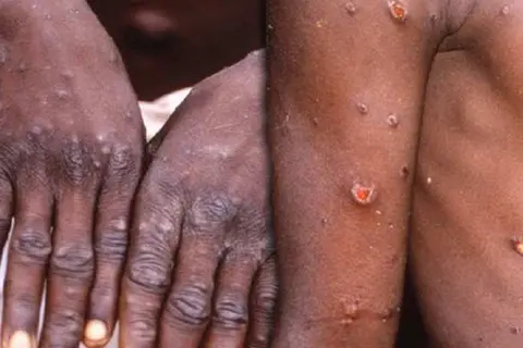 Those infected with monkeypox will typically experience a fever, intense headache, muscle aches, back pain, low energy, swollen lymph nodes and a skin rash or lesions. The rash usually begins within one to three days of the start of a fever. Number of lesions can range between a few to several thousands.